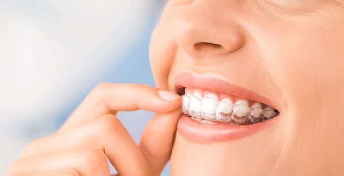 Invisalign in Panama