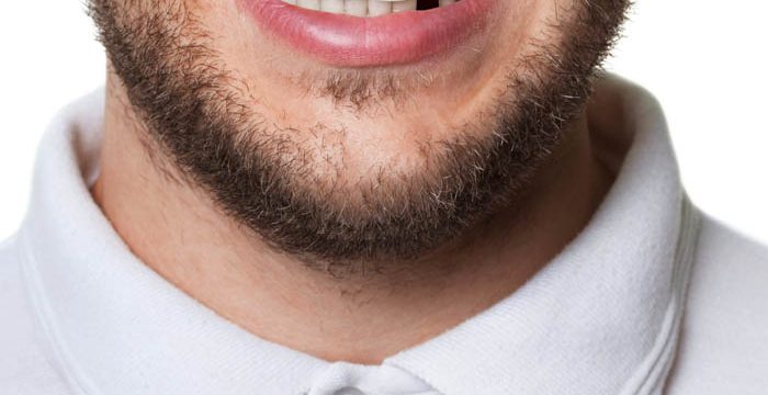 pieza dental perdida en Panamá - missing teeth in Panama
