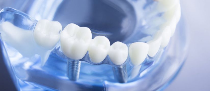 Dental Implant in Panama