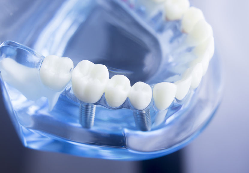 Implante Dental en Panama