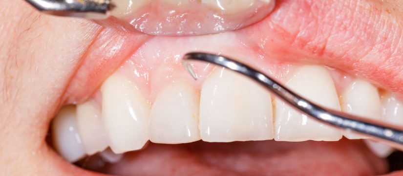 Tratamiento periodontal en Panamá