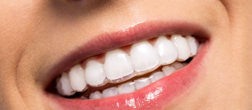 How much does it cost to zoom whiten your teeth