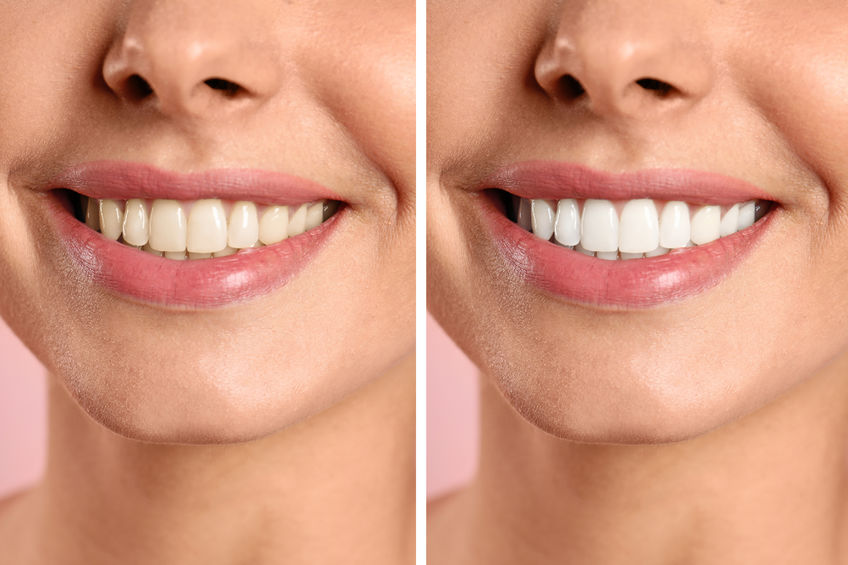 Blanqueamiento y estética dental en Panama