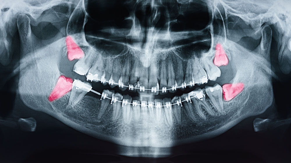 Erupted Wisdom Tooth Extraction in Panama