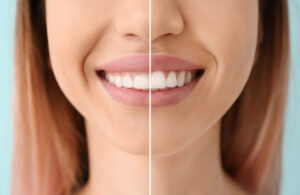 Gingivoplasty in Panama